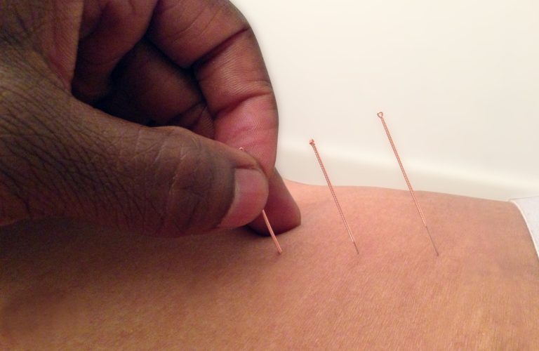 Bromley Acupuncture
